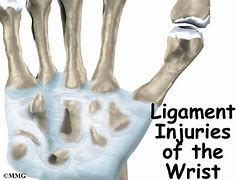 Image result for Torn Ligament in Wrist