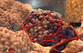Image result for What Is Solid Tumor Cancer