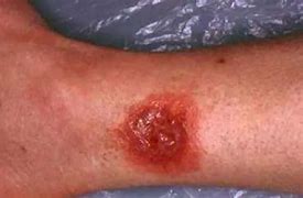 Image result for Brown Wolf Spider Bite