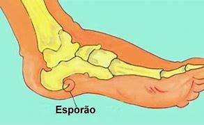 Image result for espolonear