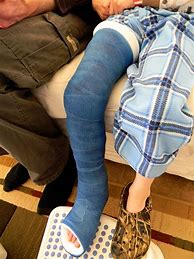 Image result for Child Broken Leg with Cast