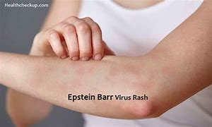 Image result for Virus Skin Rash