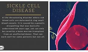 Image result for Sickle Cell Disease Symptoms