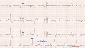 Image result for VPC ECG