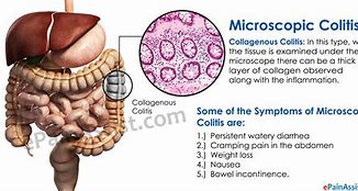 Image result for colitis_microscopica
