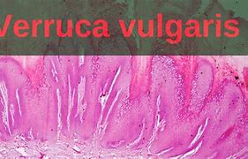 Image result for Verruca Vulgaris Pathology