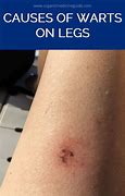 Image result for Molluscum Contagiosum in Adults Legs