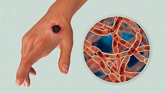 Image result for Anthrax Disease