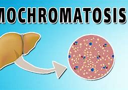 Image result for hemocromatisis