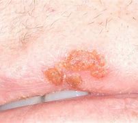 Image result for Cold Sore above Lip