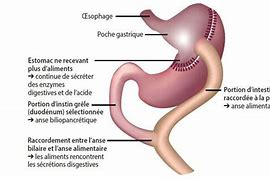 Image result for Bypass Gastrique