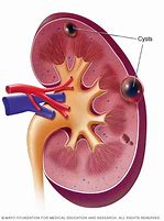 Image result for Complex Cyst On Kidney Pole