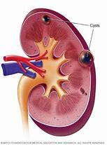 Image result for Small Simple Cyst