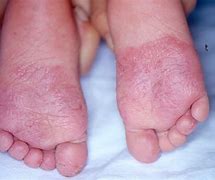 Image result for Athlete's Foot Children