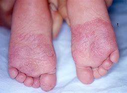 Image result for Toddler Athlete's Foot