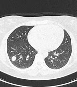 Image result for Solitary Nodule of Lung 6Cm