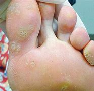 Image result for Warts On Feet