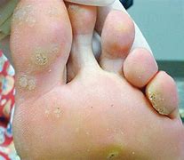 Image result for Cluster Warts On Foot