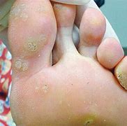 Image result for Feet Warts