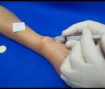 Image result for De Quervain Injection