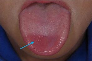 Image result for Lie Bump On Tip of Tongue