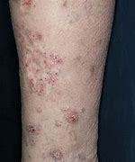 Image result for Verrucous Skin Lesion