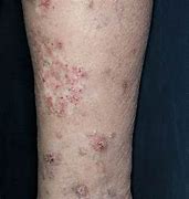 Image result for Skin Eruptions On Legs