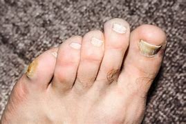 Image result for Pinky Toe Corn