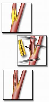 Image result for Carotid Artery Endarterectomy