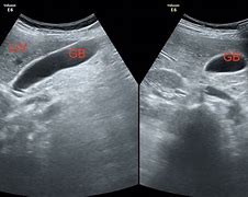 Image result for Liver and Gallbladder Ultrasound