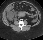 Image result for Appendix Cancer Staging