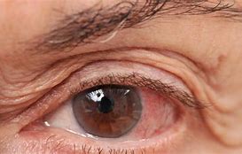 Image result for glaucoma