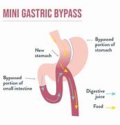 Image result for Mini Bypass