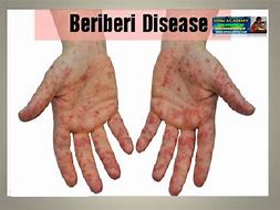 Image result for Scartis Disease