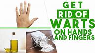 Image result for How to Remove Warts On Hands
