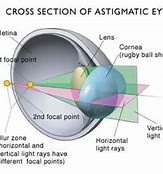 Image result for Astigmatism Eye Shape