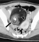 Image result for Teratoma Cyst