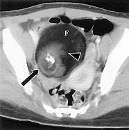 Image result for Ovarian Teratoma Ultrasound