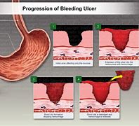 Image result for Bleeding Ulcer