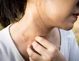 Image result for Pictures of Eczema