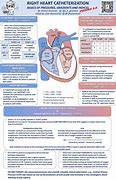 Image result for Heart Catheterization Recovery