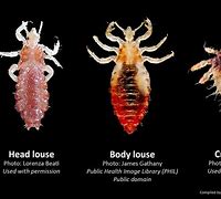 Image result for Crabs STD vs Lice
