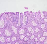 Image result for Adenomatous Colon Polyps