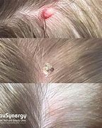 Image result for Skin Tags Back of Head