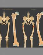 Image result for Rickets Vector