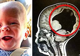 Image result for Child without Brain