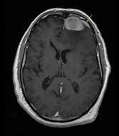 Image result for Meningioma Brain Tumor
