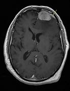 Image result for Meningioma Brain Tumors 1 Cm