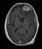 Image result for Meningioma Tumor MRI Images