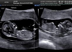 Image result for 12 Weeks Pregnant Ultrasound Twins